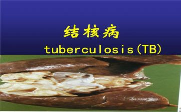 防治结核病活动总结5篇