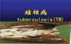 防治结核病活动总结5篇